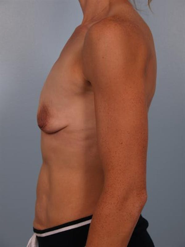 Breast Lift Before & After Gallery - Patient 1310542 - Image 5