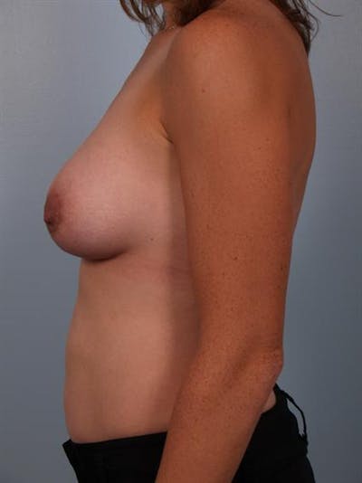 Breast Lift Before & After Gallery - Patient 1310542 - Image 6