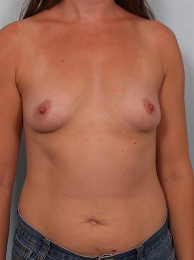 Breast Augmentation Before & After Gallery - Patient 1310550 - Image 1