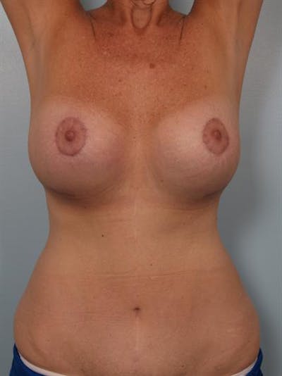 Complex Breast Revision Before & After Gallery - Patient 1310544 - Image 6