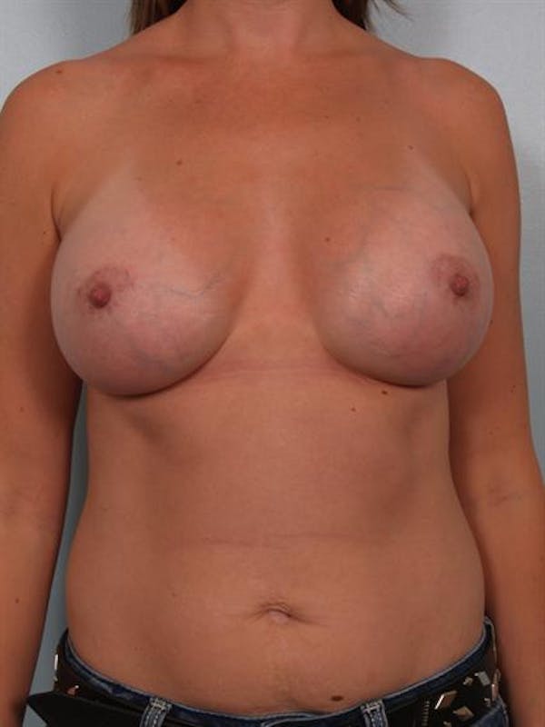 Breast Augmentation Before & After Gallery - Patient 1310550 - Image 2
