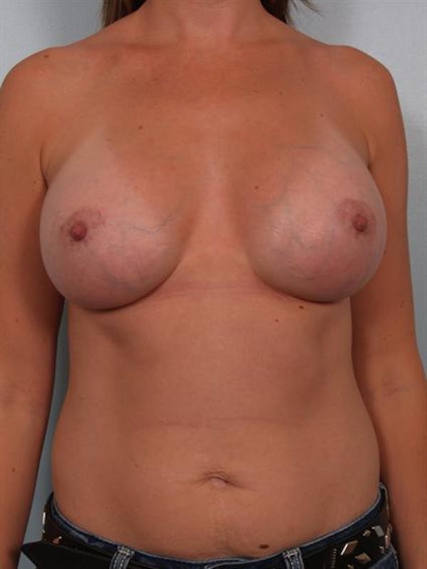 Breast Augmentation Gallery - Patient 1310550 - Image 2