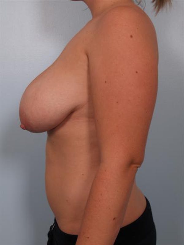 Breast Reduction Before & After Gallery - Patient 1310546 - Image 5