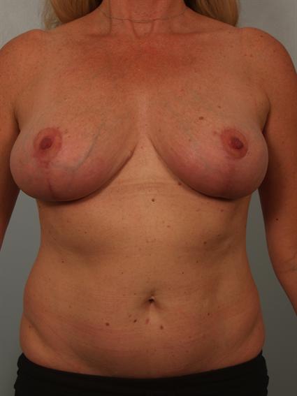 Image2 - Before and after image of Breast Fat Grafting in Beverly Hills by Dr. Cohen.