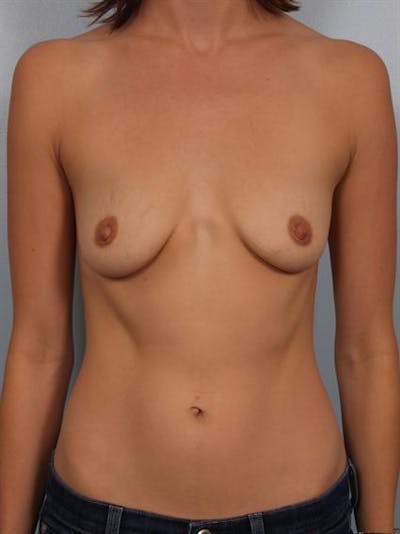 Breast Lift Gallery - Patient 1310554 - Image 1