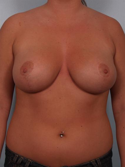 after image of Breast Reduction by Dr. Cohen.