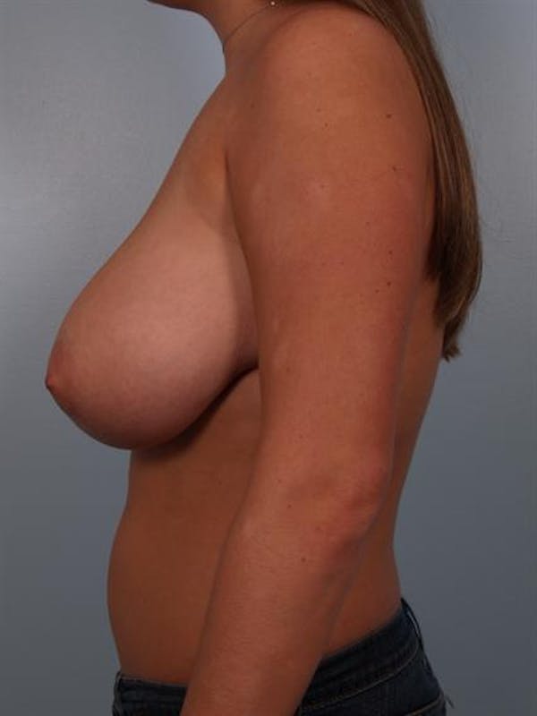 Breast Reduction Before & After Gallery - Patient 1310555 - Image 3