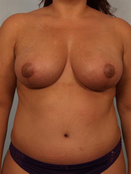 Image3 - Before and after image of Breast Fat Grafting in Beverly Hills by Dr. Cohen.