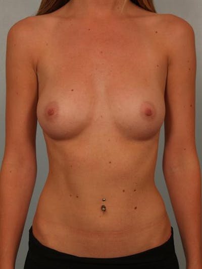 Breast Augmentation Before & After Gallery - Patient 1310558 - Image 1