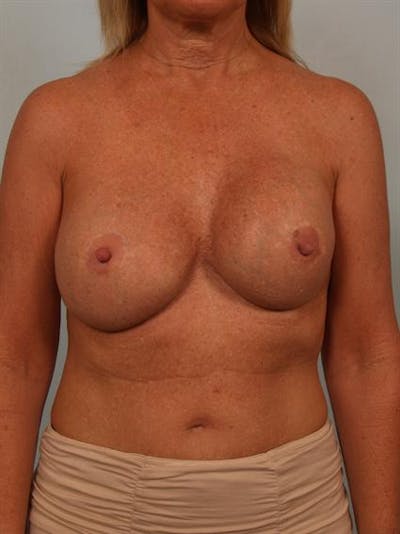 Complex Breast Revision Before & After Gallery - Patient 1310560 - Image 1