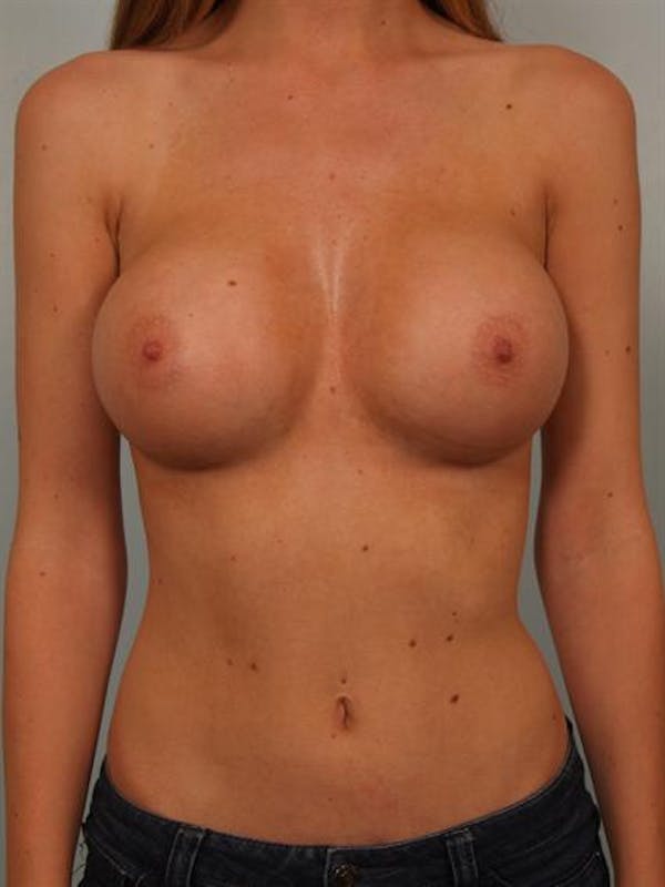 Breast Augmentation Gallery - Patient 1310558 - Image 2