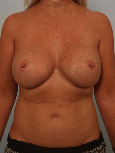 Complex Breast Revision Before & After Gallery - Patient 1310560 - Image 2