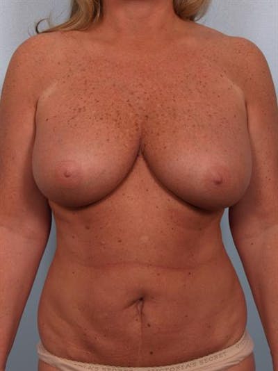 Breast Reduction Before & After Gallery - Patient 1310563 - Image 1