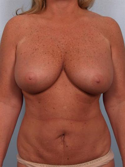 Breast Reduction Gallery - Patient 1310563 - Image 1
