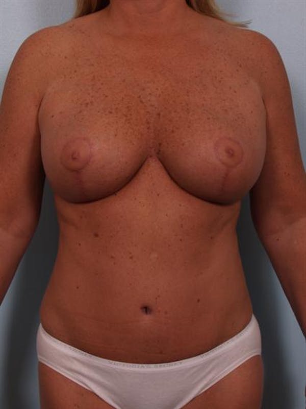 Breast Reduction Before & After Gallery - Patient 1310563 - Image 2