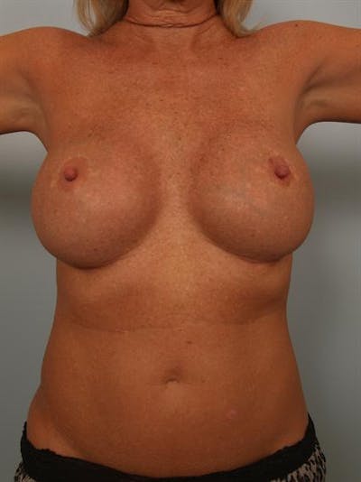 Complex Breast Revision Before & After Gallery - Patient 1310560 - Image 4