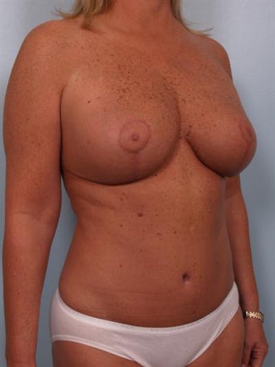 Breast Reduction Before & After Gallery - Patient 1310563 - Image 4