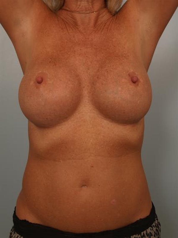 Complex Breast Revision Before & After Gallery - Patient 1310560 - Image 6