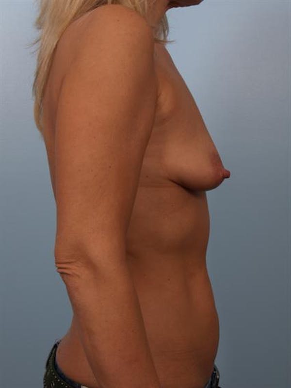 Breast Lift Before & After Gallery - Patient 1310561 - Image 5