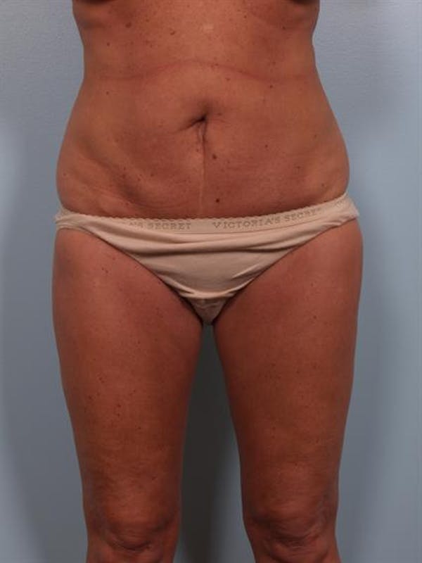 Breast Reduction Before & After Gallery - Patient 1310563 - Image 5
