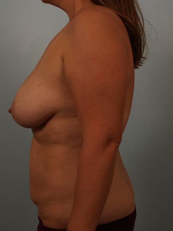 Fat Grafting Before & After Gallery - Patient 1310562 - Image 5