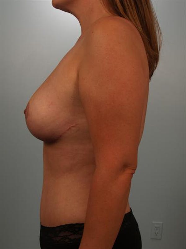 Fat Grafting Before & After Gallery - Patient 1310562 - Image 6