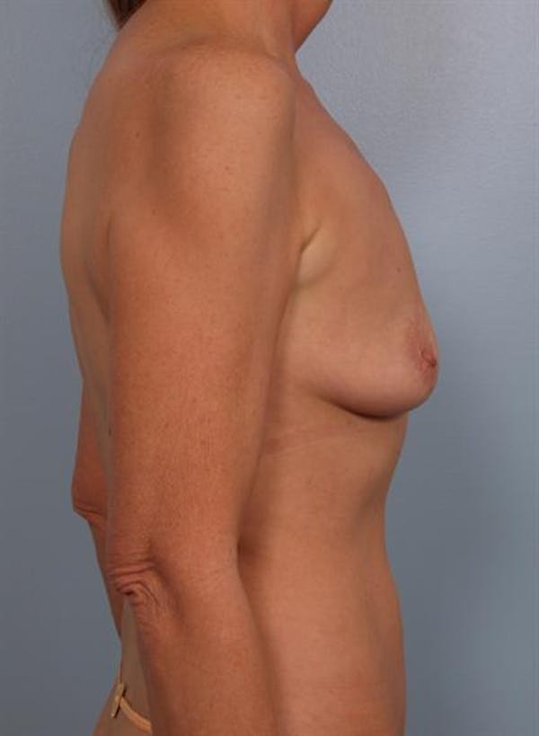Breast Augmentation Gallery - Patient 1310566 - Image 3