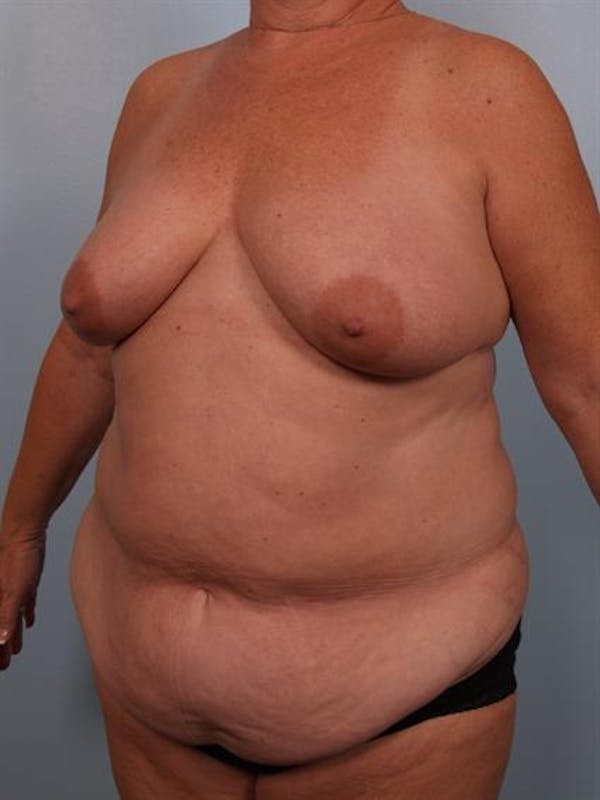 Breast Lift Before & After Gallery - Patient 1310571 - Image 3