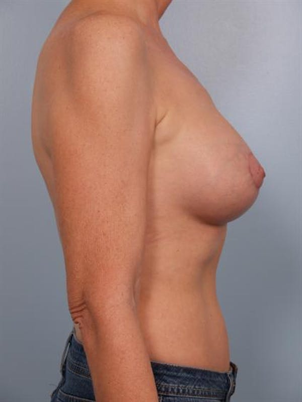 Breast Augmentation Before & After Gallery - Patient 1310566 - Image 4