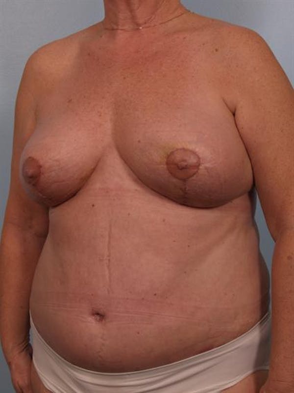 Breast Lift Before & After Gallery - Patient 1310571 - Image 4