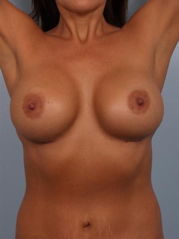 Complex Breast Revision Before & After Gallery - Patient 1310569 - Image 6