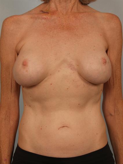 Image5 - Before and after image of Breast Fat Grafting in Beverly Hills by Dr. Cohen.