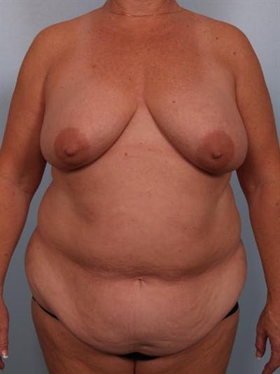Breast Lift Before & After Gallery - Patient 1310571 - Image 1