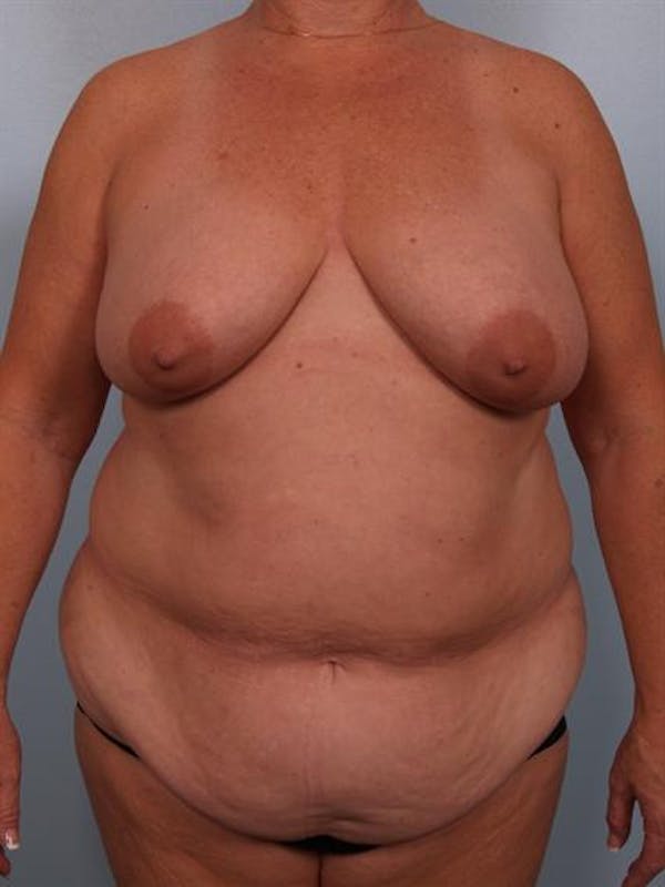 Breast Lift Before & After Gallery - Patient 1310571 - Image 1