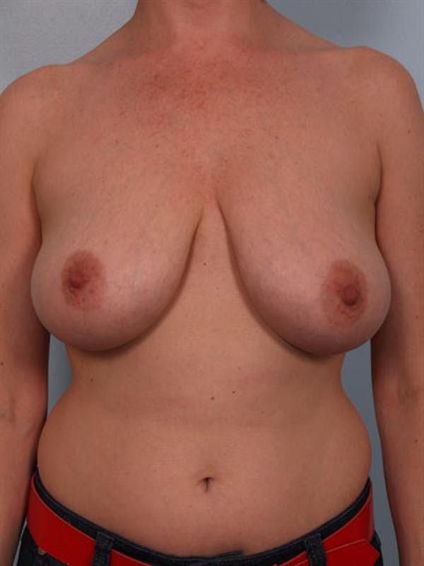 Breast Reduction Before & After Gallery - Patient 1310568 - Image 1