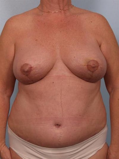 Breast Lift Before & After Gallery - Patient 1310571 - Image 2