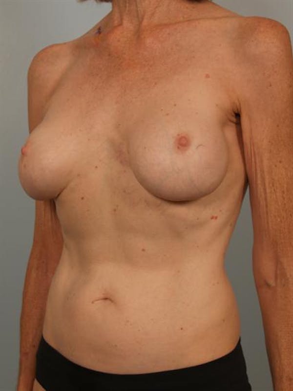 Fat Grafting Before & After Gallery - Patient 1310570 - Image 3