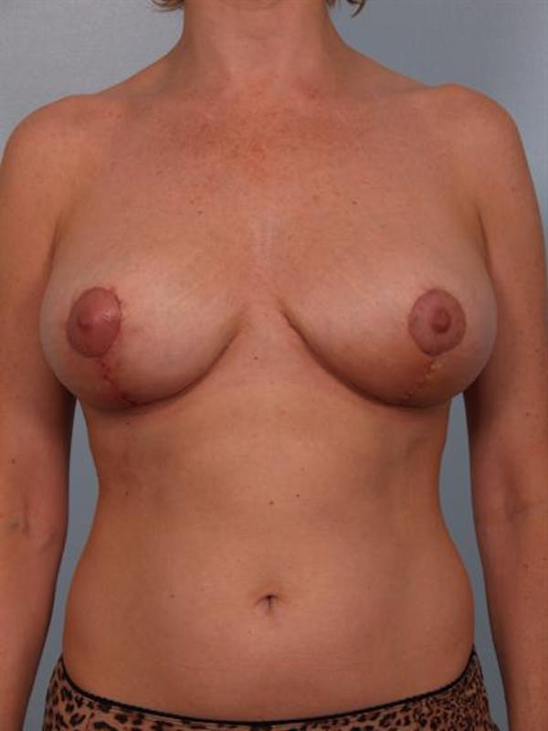 Breast Reduction Gallery - Patient 1310568 - Image 2
