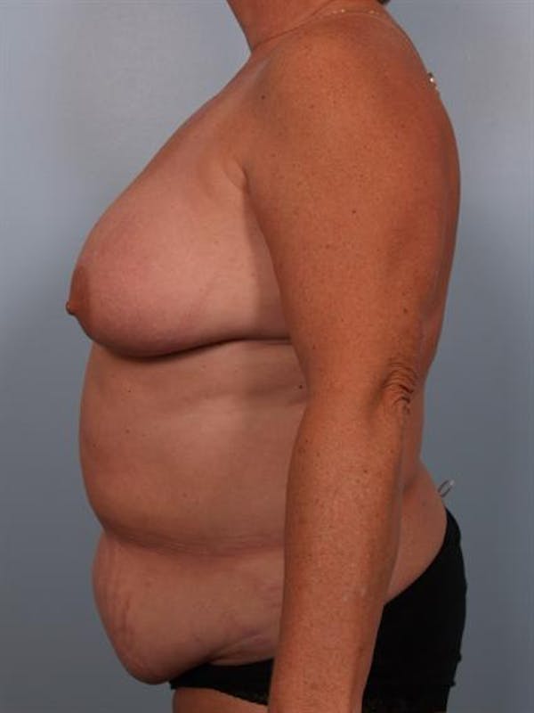 Breast Lift Before & After Gallery - Patient 1310571 - Image 5