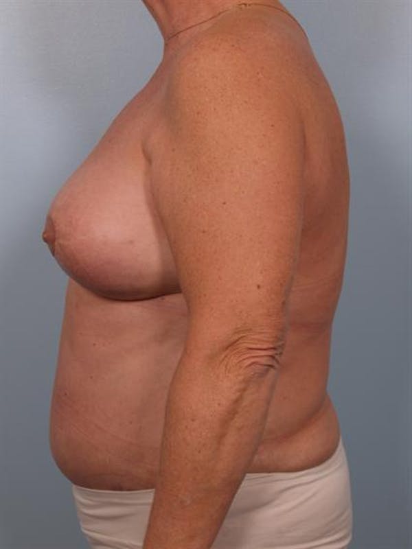 Breast Lift Before & After Gallery - Patient 1310571 - Image 6