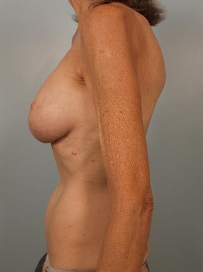 Fat Grafting Before & After Gallery - Patient 1310570 - Image 6
