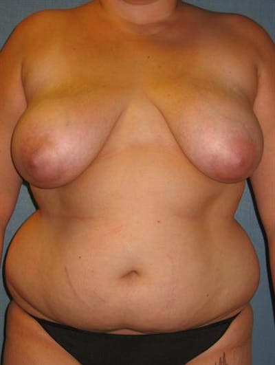Breast Reduction Gallery - Patient 1310577 - Image 1