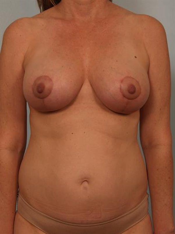 Fat Grafting Gallery - Patient 1310573 - Image 2