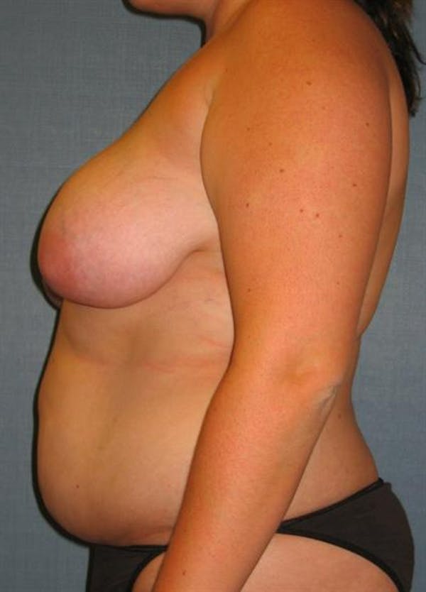 Breast Reduction Before & After Gallery - Patient 1310577 - Image 3