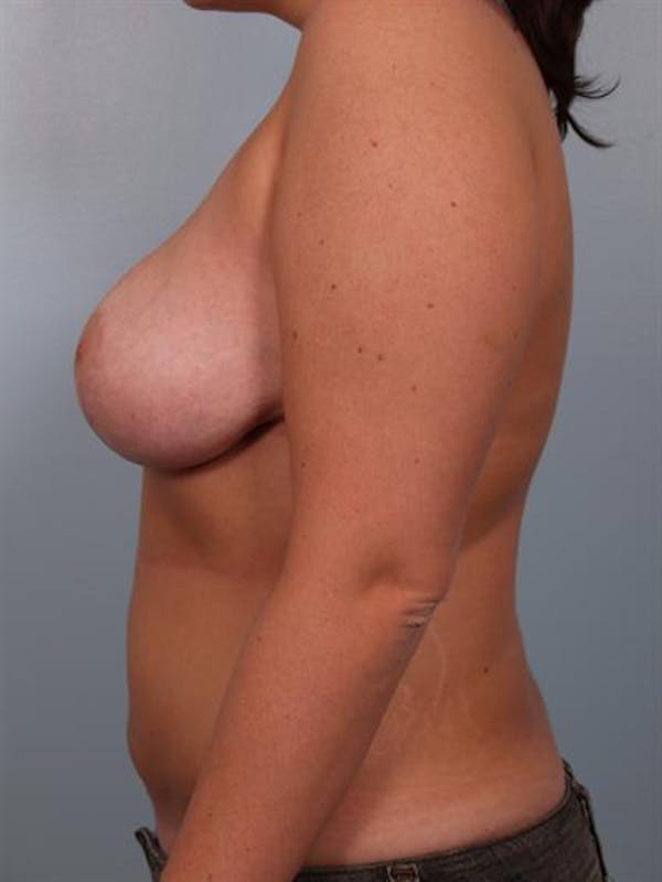 Breast Reduction Before & After Gallery - Patient 1310577 - Image 4