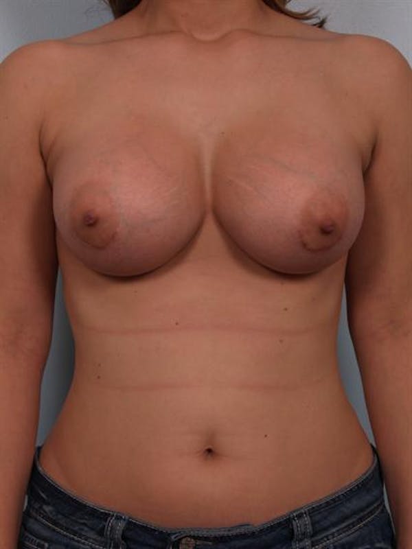 Breast Augmentation Gallery - Patient 1310575 - Image 6