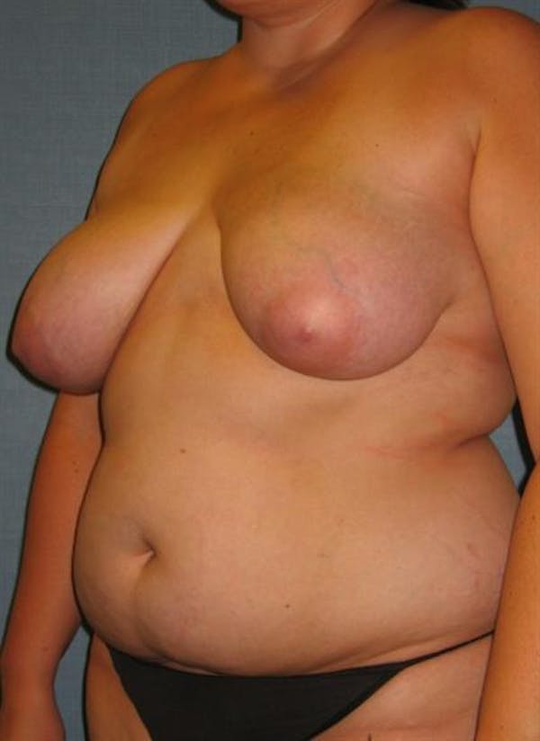 Breast Reduction Before & After Gallery - Patient 1310577 - Image 7