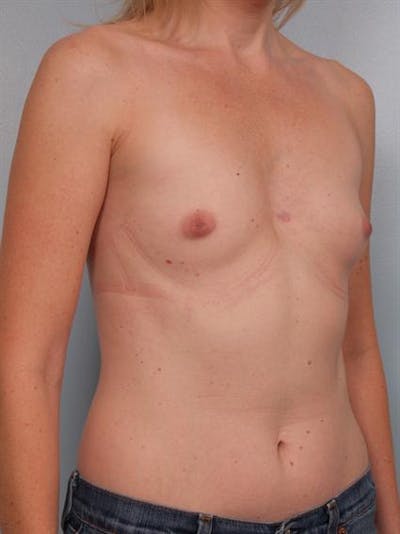 Breast Augmentation Before & After Gallery - Patient 1310582 - Image 1
