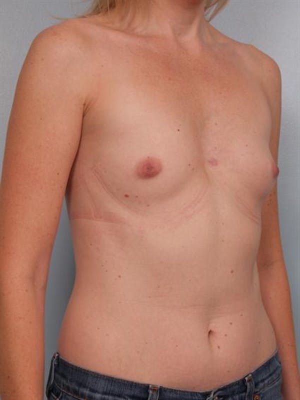 Breast Augmentation Before & After Gallery - Patient 1310582 - Image 1