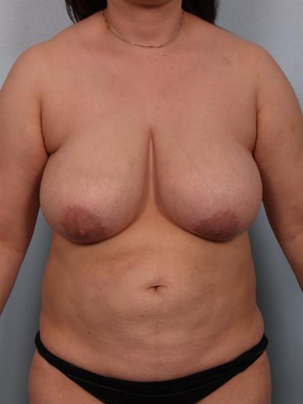 Breast Reduction Before & After Gallery - Patient 1310580 - Image 1